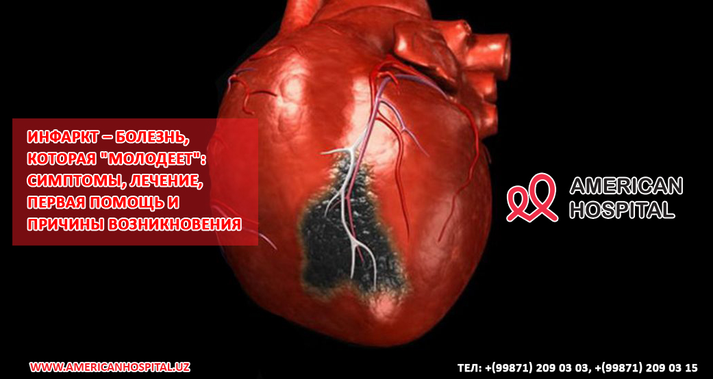 Инфаркт – болезнь, которая "молодеет": симптомы, лечение, первая помощь и причины возникновения