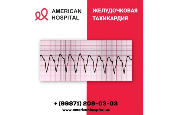 Желудочковая тахикардия