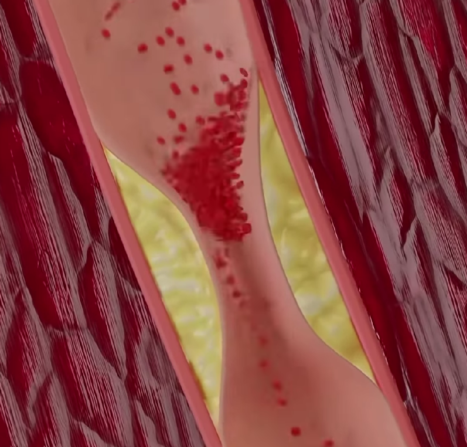  Как можно предотвратить инфаркт миокарда?