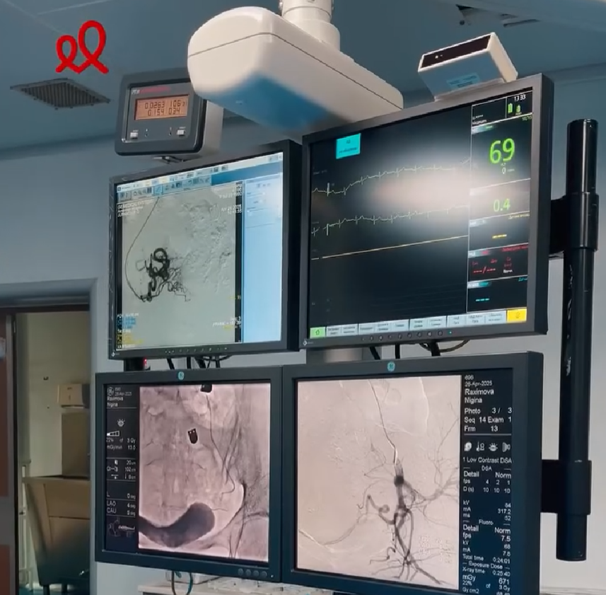  Embolizatsiya operatsiyasi — yana bir muvaffaqiyatli natija